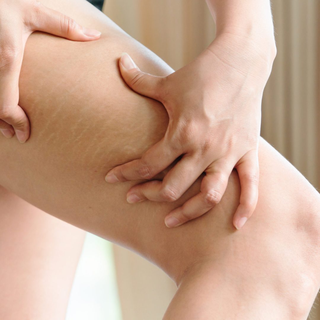 Female hand holds fat cellulite and stretch mark on leg at home, women diet style concept